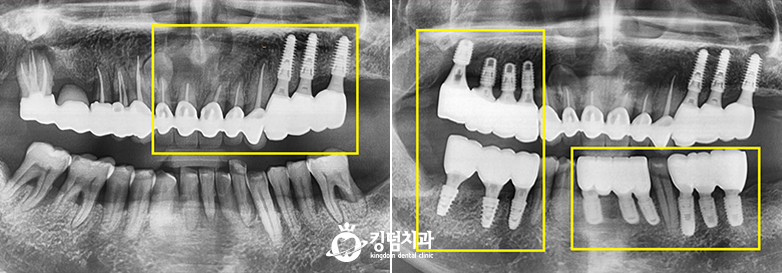 킹덤치과 전후사진