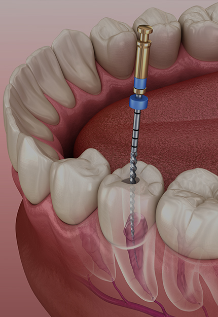 자연치아 살리기