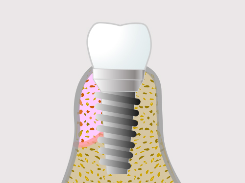 임플란트 식립 및 보철물 결합