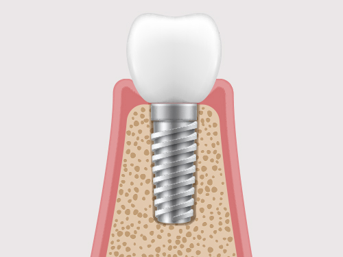보철물 식립(크라운)