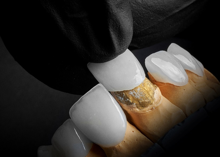 최소삭제 라미네이트