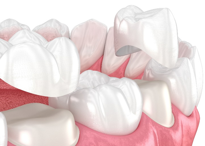 무삭제 라미네이트